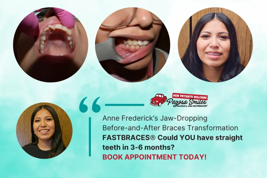 FastBraces Pagosa Springs: Real Before & After Braces in Just 3-6 Months